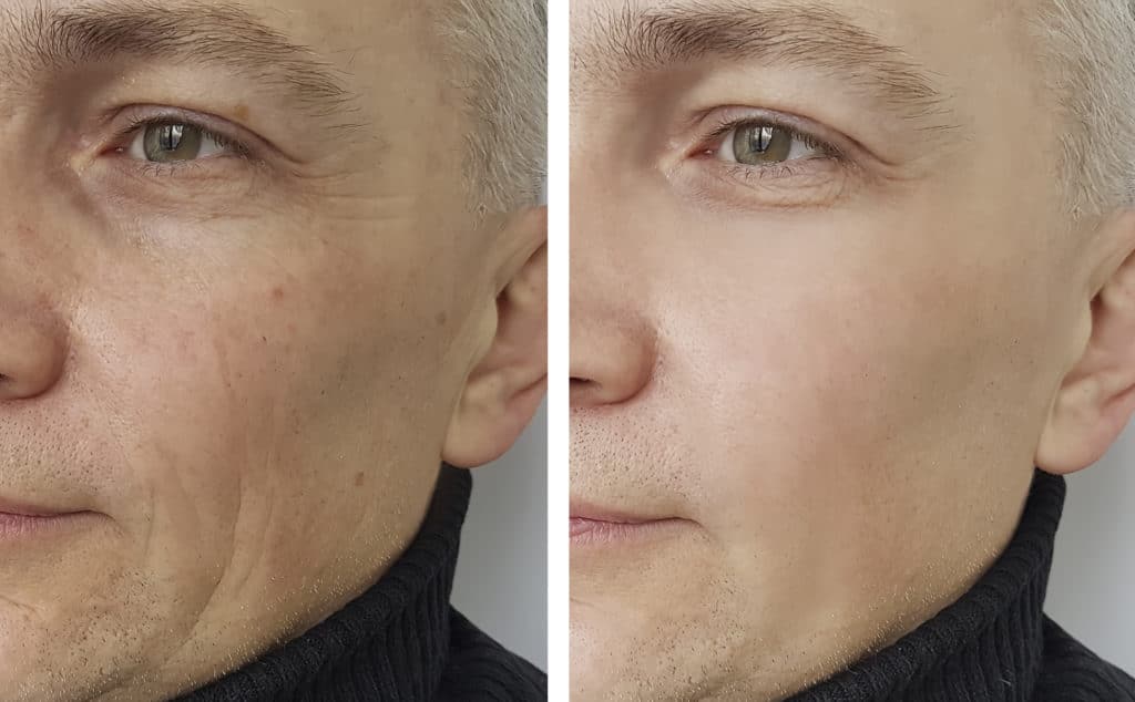 5 facts about the fat transfer procedure in fat transfer 5f32dc7097e4d