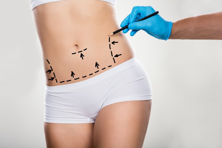 tummy tuck vs liposuction in liposuction 5f32dbfa21776