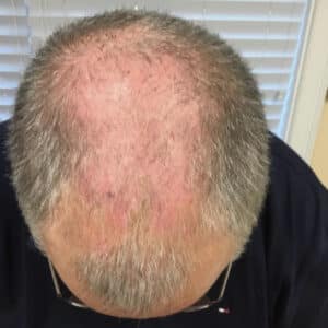 HairRestoration Before male-actual patient