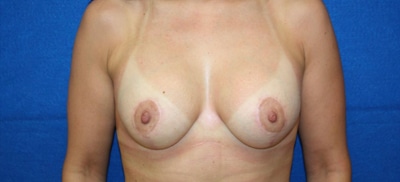 Breast Lift After