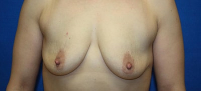 Breast Lift Before