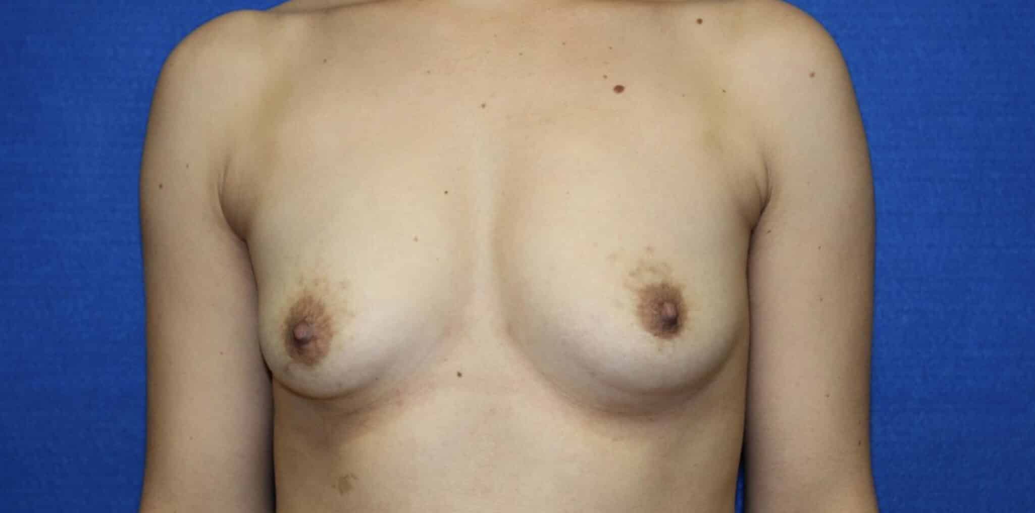 BreastAugmentationPt2-before
