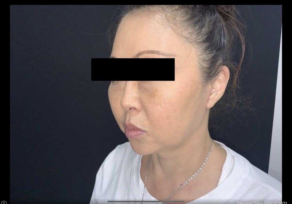 FaceLift pt2-after