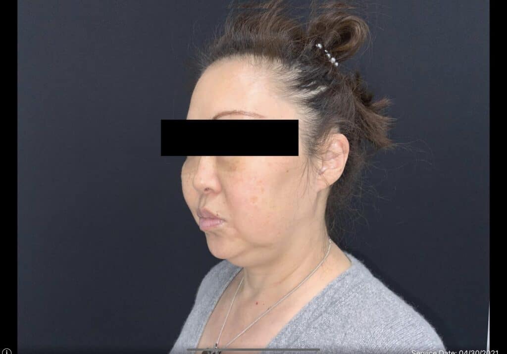 FaceLift pt2-before