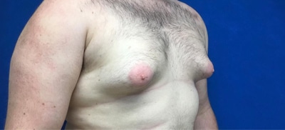 Male Breast Reduction - Before
