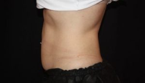 Coolsculpting