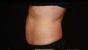 Coolsculpting