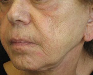 Facelift