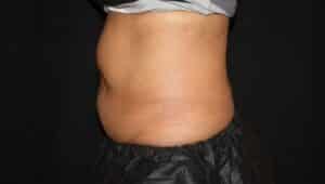Coolsculpting