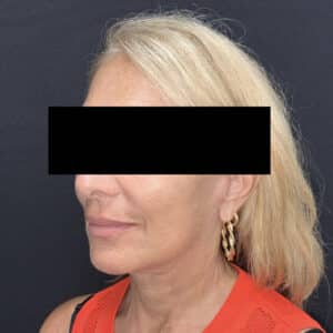 Facelift
