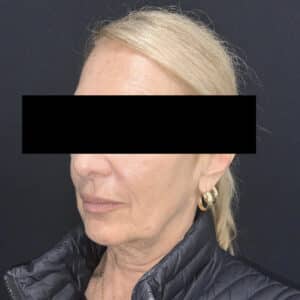 Facelift