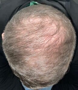 Hair Restoration