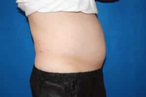 Coolsculpting