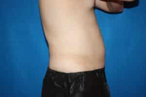 Coolsculpting