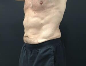 Coolsculpting