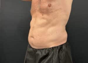Coolsculpting