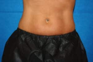 Coolsculpting