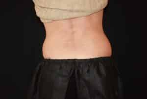 Coolsculpting