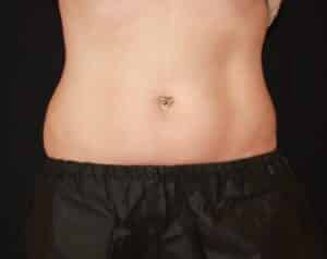 Coolsculpting