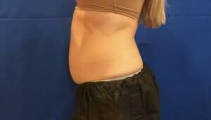 Coolsculpting