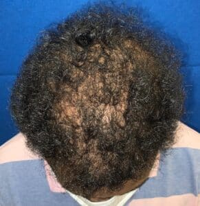 Hair Restoration