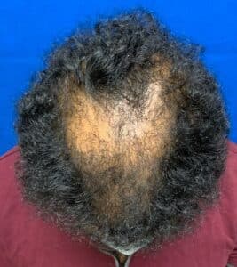 Hair Restoration