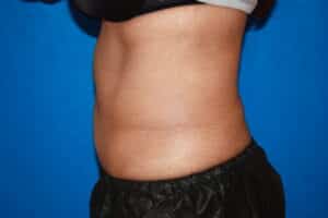 Coolsculpting
