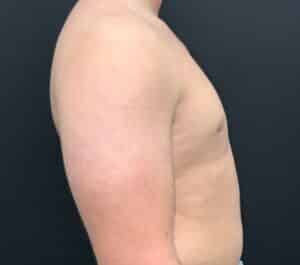 Gynecomastia (Male Breast Reduction)