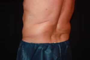 Coolsculpting