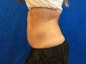 Coolsculpting
