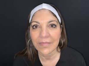 Volux (Jawline filler)