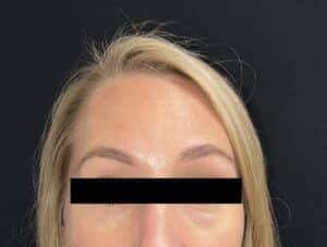 Botox