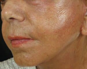 Facelift