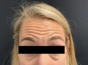 Botox