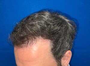 Hair Restoration