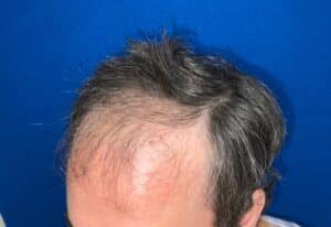 Hair Restoration