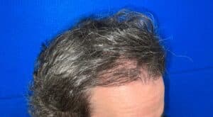 Hair Restoration