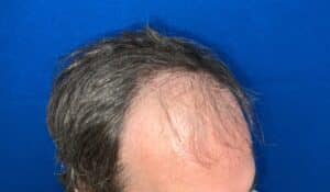 Hair Restoration