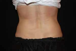 Coolsculpting