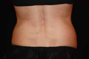 Coolsculpting