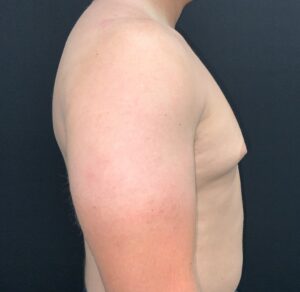 Gynecomastia (Male Breast Reduction)