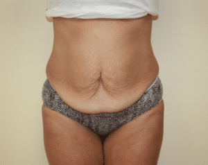 Tummy Tuck
