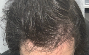 Hair Restoration