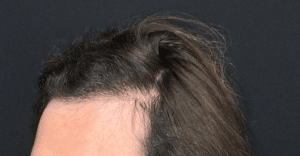 Hair Restoration
