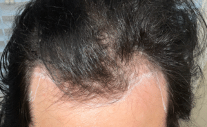 Hair Restoration