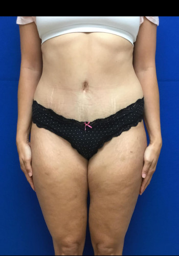 Tummy Tuck
