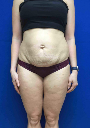 Tummy Tuck