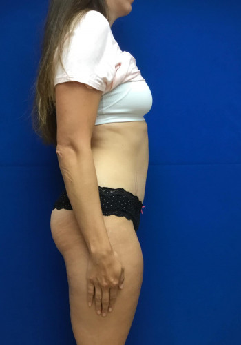 Tummy Tuck