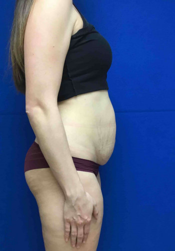 Tummy Tuck