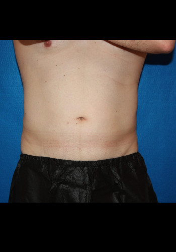 CoolSculpting